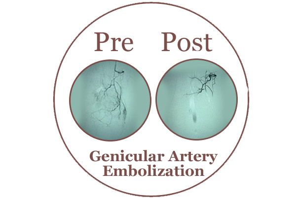 Genicular Artery Embolization